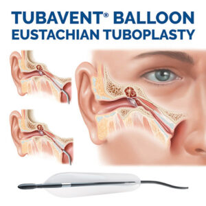 TubaVent Eustachian Tube Dilatation